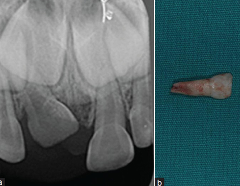 dental trauma