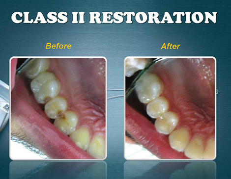 fillings and restorations