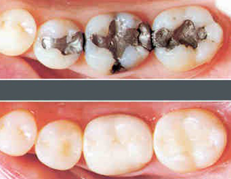 fillings and restorations