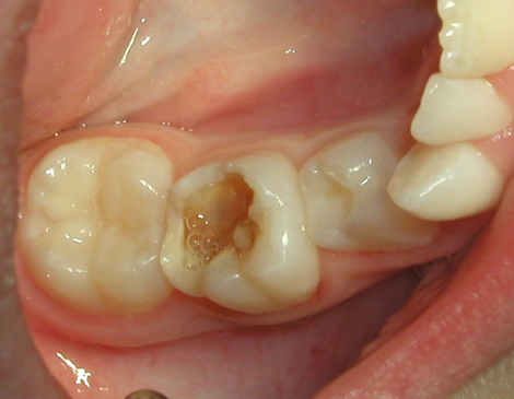 fillings and restorations