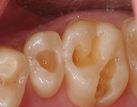 fillings and restorations