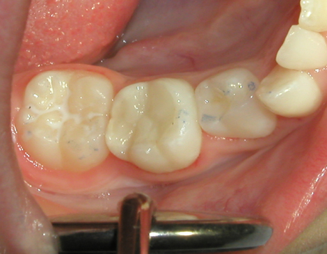 fillings and restorations