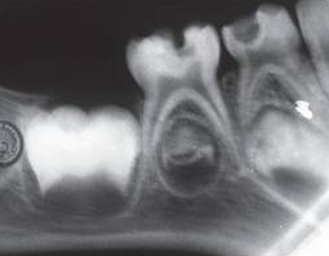 root canal endodontic treatment