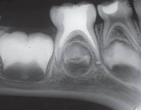 root canal endodontic treatment