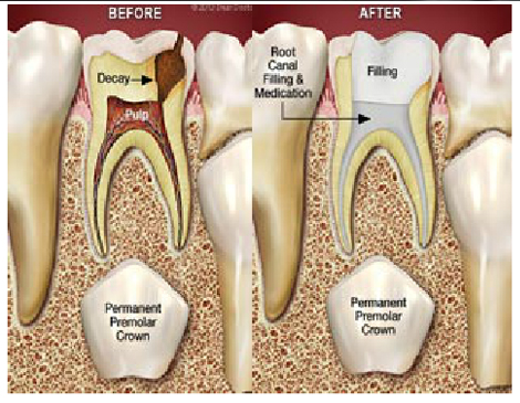 root canal endodontic treatment